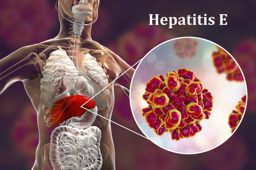 bigstock-Hepatitis-E-Viral-Infection-247374850-e1568915255101.jpg bigstock-Hepatitis-E-Viral-Infection-247374850-e1568915255101.jpg