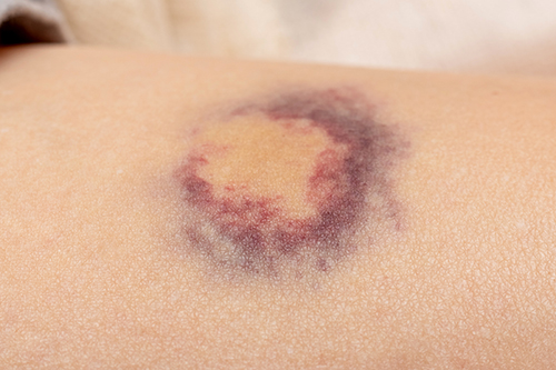 hematoma-woman-s-body-as-result-violence.jpg hematoma-woman-s-body-as-result-violence.jpg